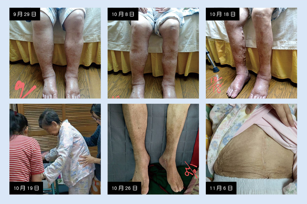 三軍醫訊NO256圖一顏女士雙腳水腫與腹水逐漸消退且可在家人協助下行走相片由顏女士女兒提供